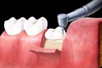 third-molar-removal